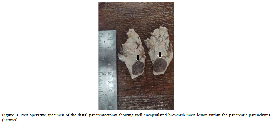 pancreas-pancreatic-parenchyma