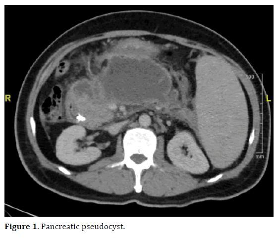 pancreas-pancreatic-pseudocyst