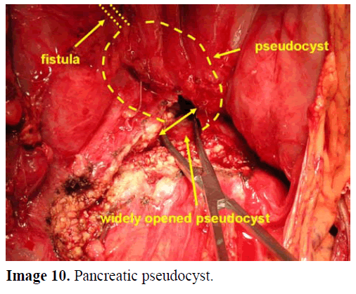 pancreas-pancreatic-pseudocyst
