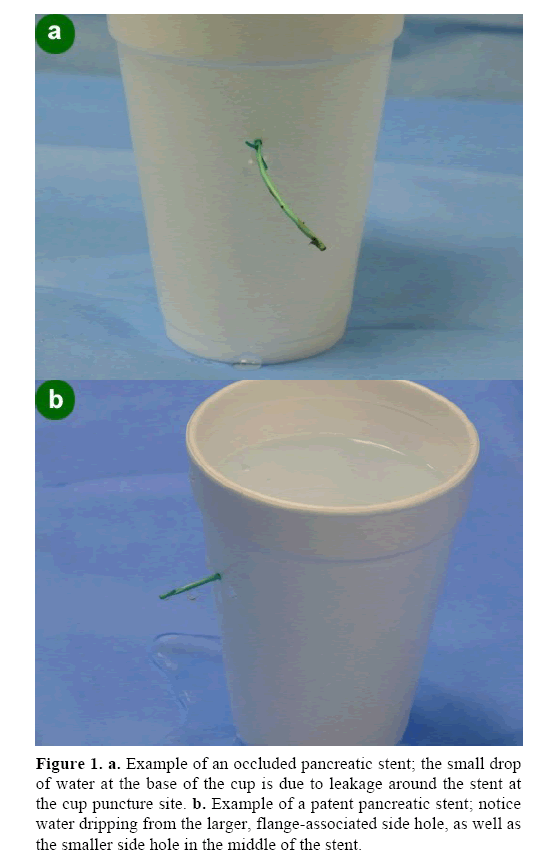 pancreas-pancreatic-stent