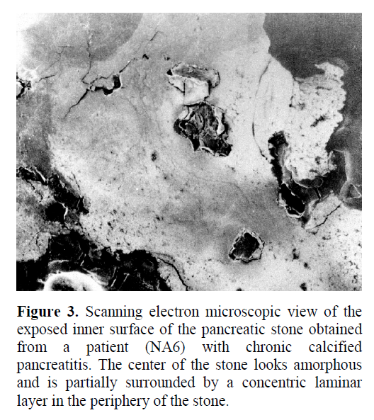 pancreas-pancreatic-stone-obtained