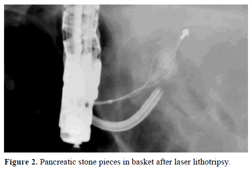 pancreas-pancreatic-stone-pieces-basket