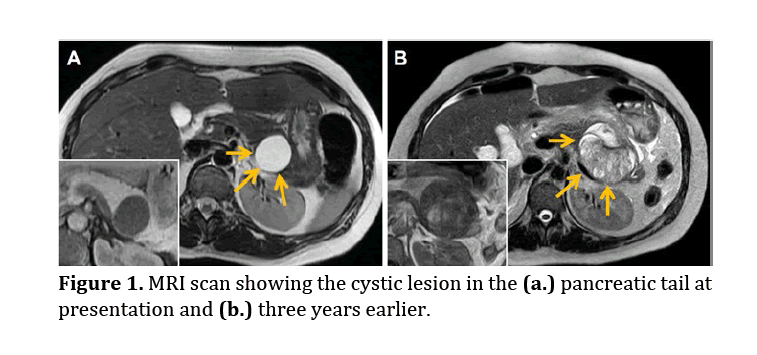 pancreas-pancreatic-tail