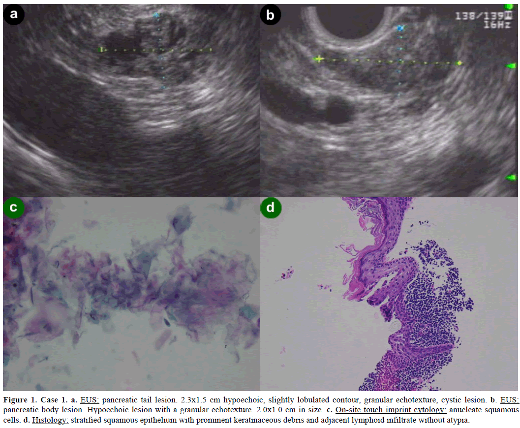 pancreas-pancreatic-tail-lesion