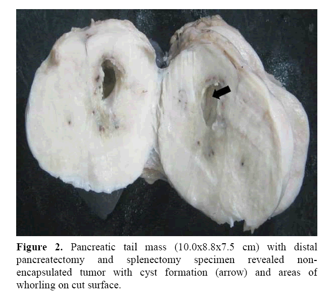 pancreas-pancreatic-tail-mass