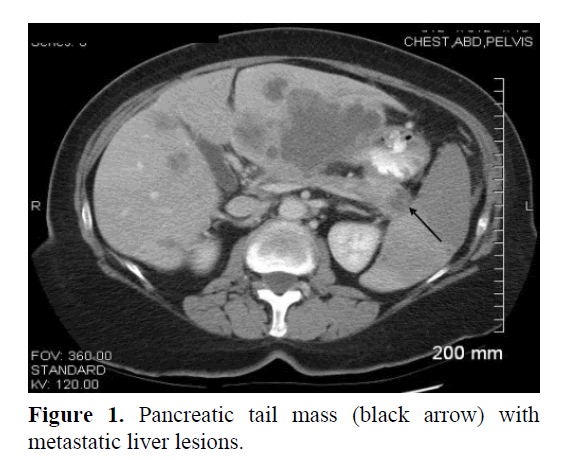 pancreas-pancreatic-tail-mass