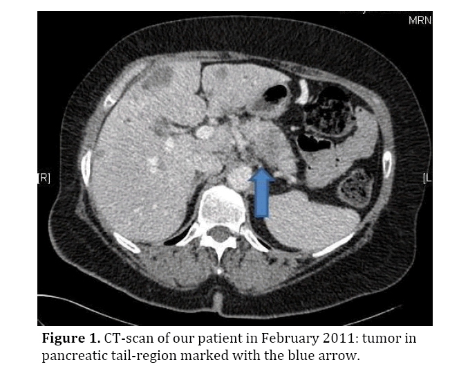 pancreas-pancreatic-tail-region