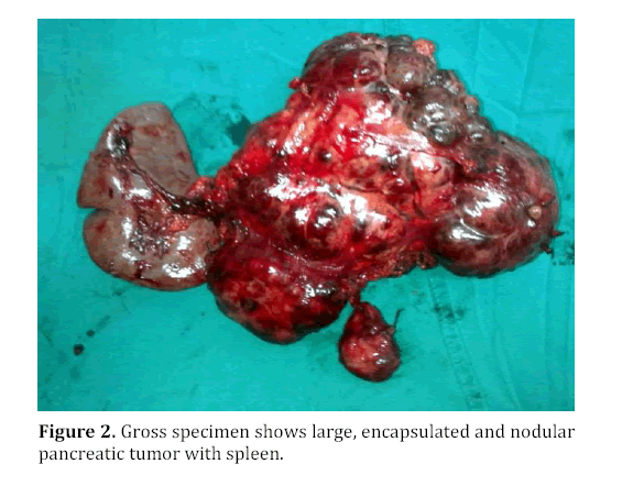 pancreas-pancreatic-tumor-spleen