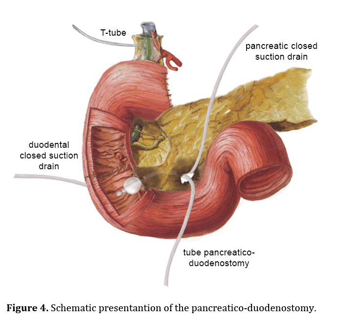 pancreas-pancreatico-duodenostomy