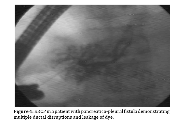 pancreas-pancreatico-pleural-fistula