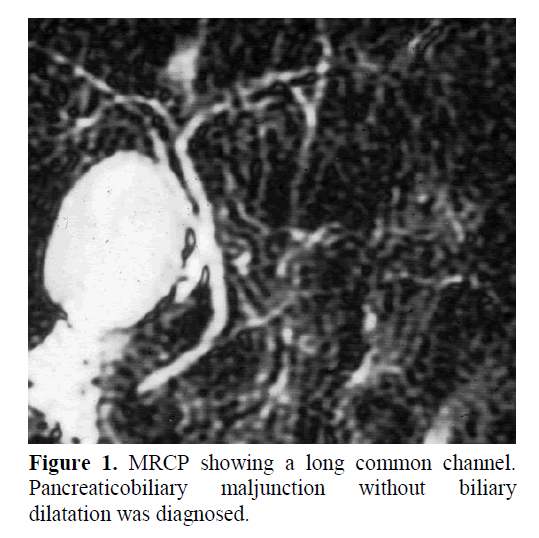 pancreas-pancreaticobiliary-maljunction