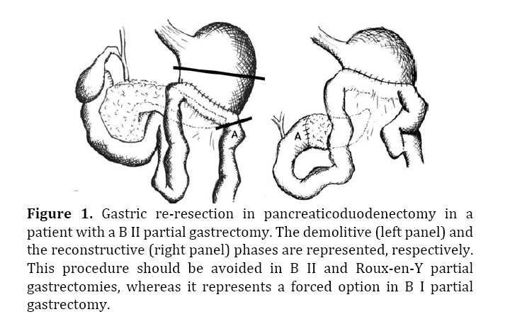 pancreas-pancreaticoduodenectomy