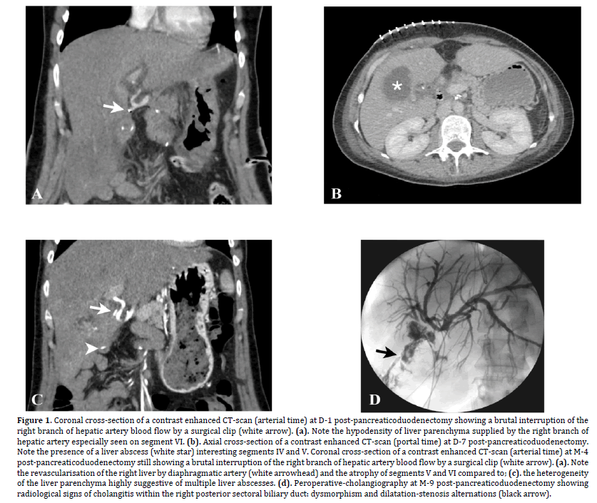 pancreas-pancreaticoduodenectomy