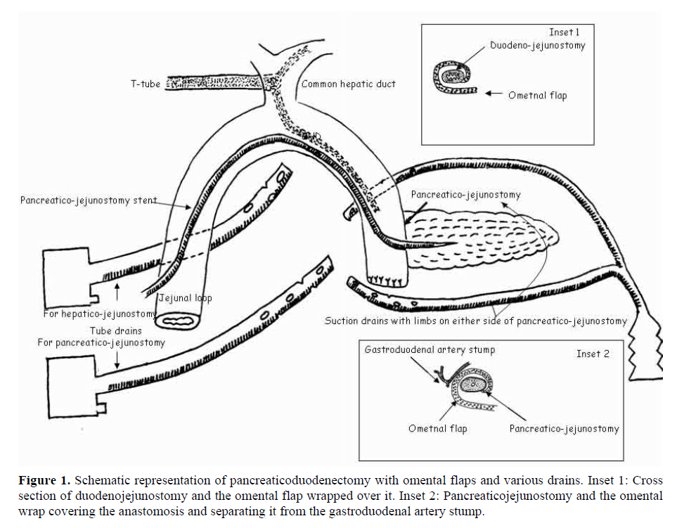 pancreas-pancreaticoduodenectomy