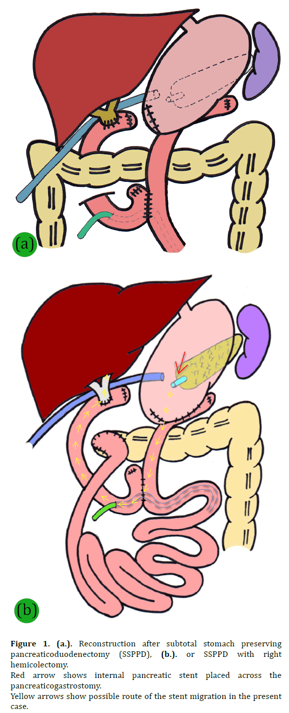 pancreas-pancreaticoduodenectomy-pancreatic-stent