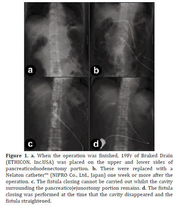 pancreas-pancreaticoduodenectomy-portionc