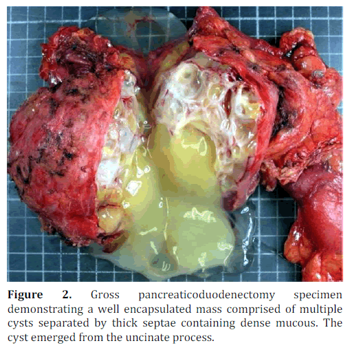 pancreas-pancreaticoduodenectomy-septae-mucous