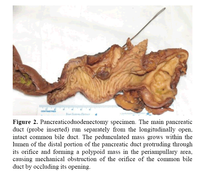 pancreas-pancreaticoduodenectomy-specimen