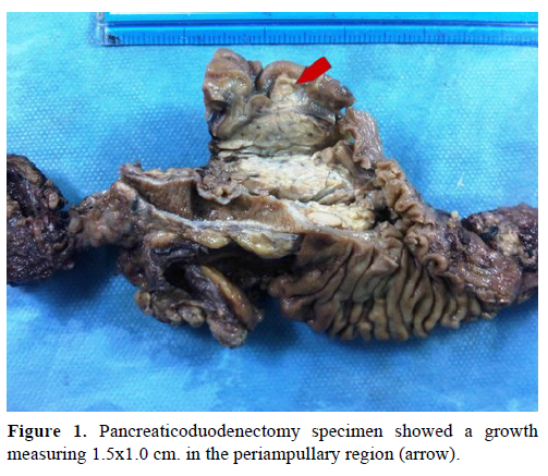 pancreas-pancreaticoduodenectomy-specimen