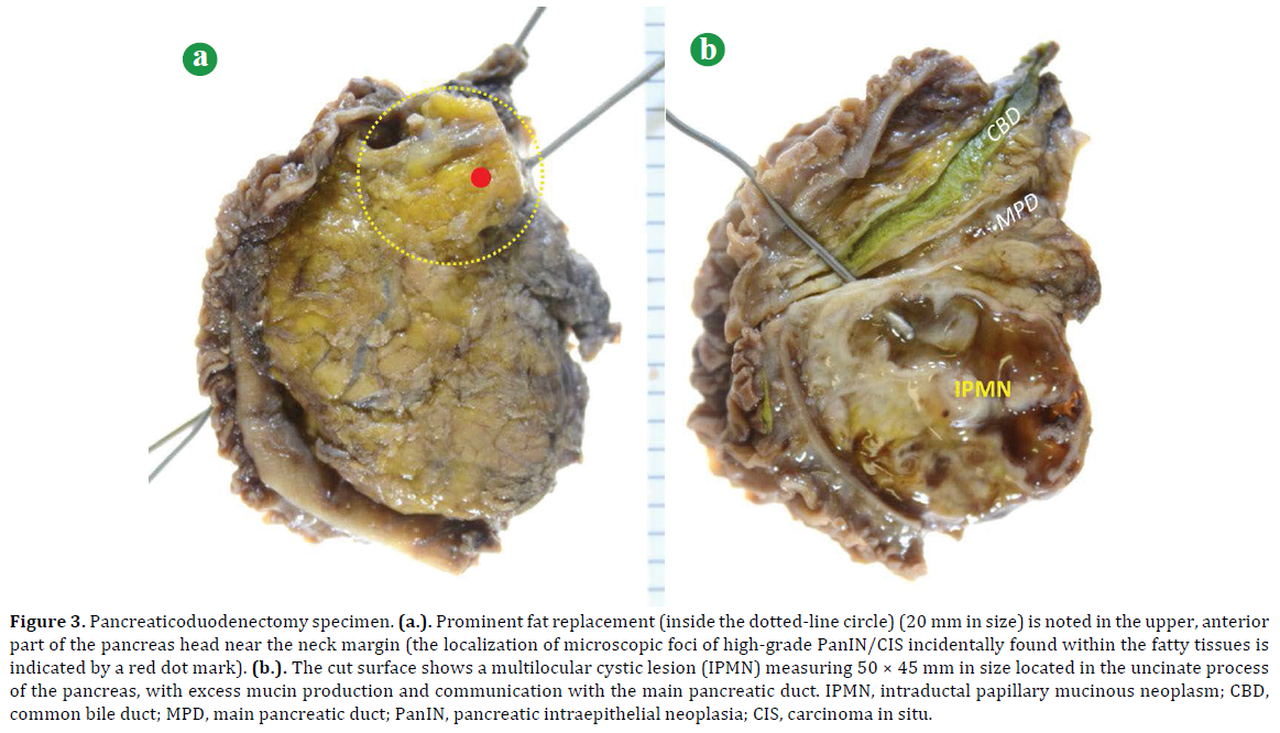 pancreas-pancreaticoduodenectomy-specimen