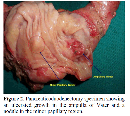 pancreas-pancreaticoduodenectomy-specimen