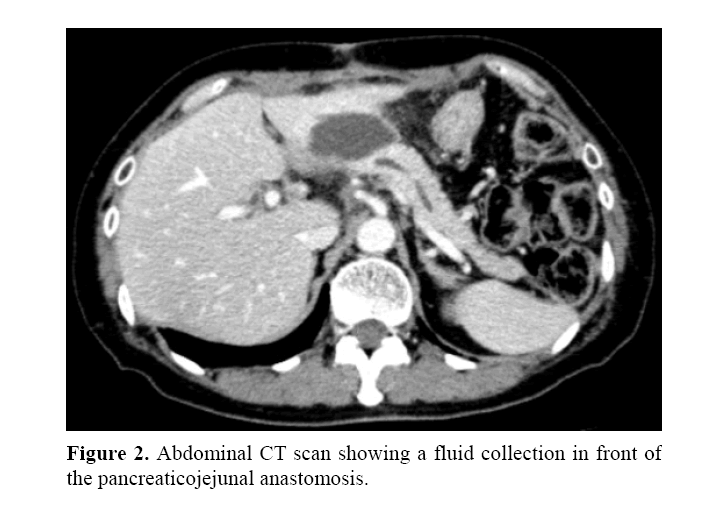 pancreas-pancreaticojejunal-anastomosis