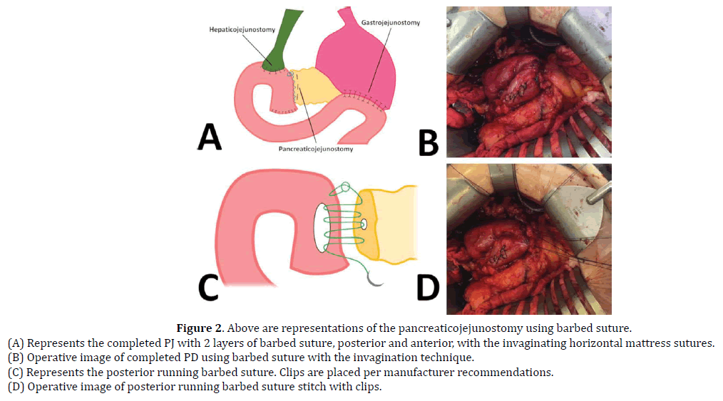 pancreas-pancreaticojejunostomy