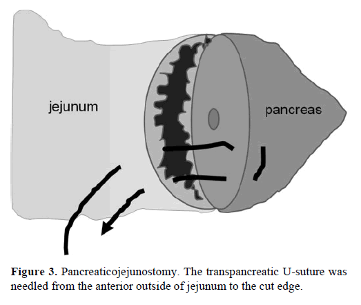 pancreas-pancreaticojejunostomy-anterior