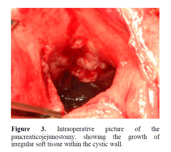 pancreas-pancreaticojejunostomy-soft-tissue