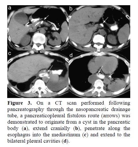 pancreas-pancreaticopleural-fistulous-route