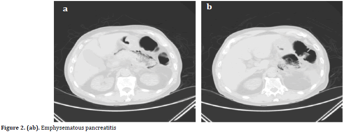 pancreas-pancreatitis