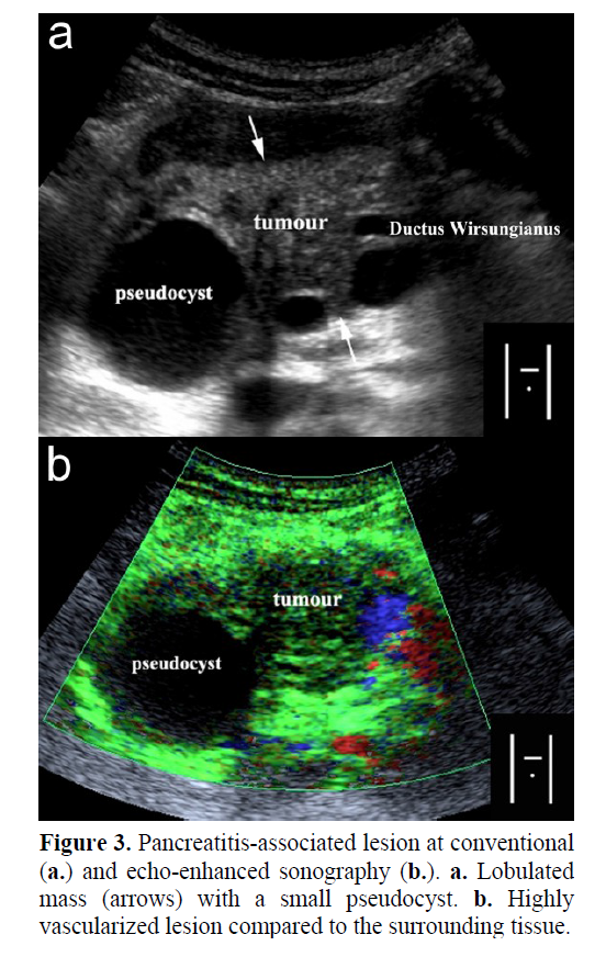 pancreas-pancreatitis-associated-lesion