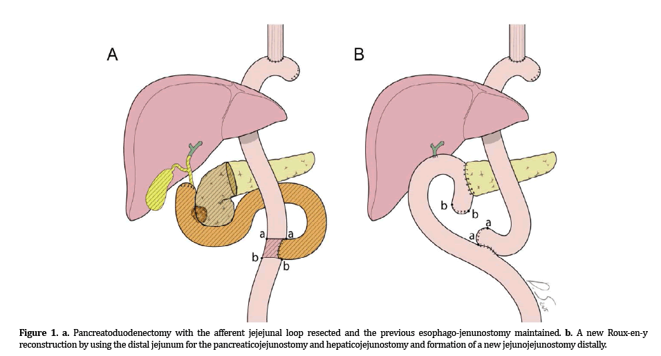pancreas-pancreatoduodenectomy