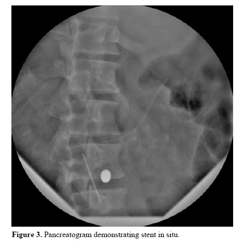 pancreas-pancreatogram-demonstrating