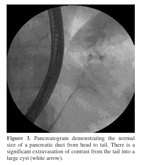 pancreas-pancreatogram-demonstrating
