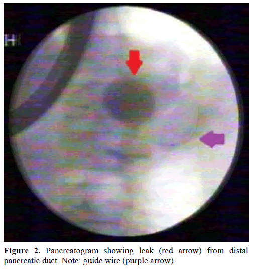 pancreas-pancreatogram-distal