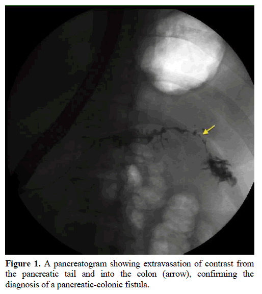 pancreas-pancreatogram-extravasation