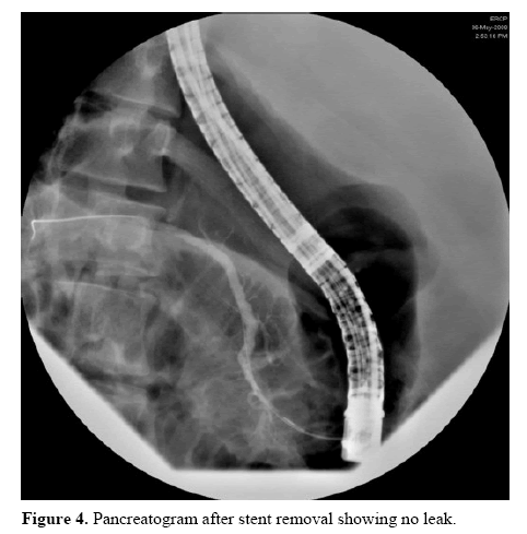 pancreas-pancreatogram-stent