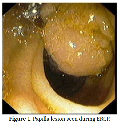 pancreas-papilla-lesion-during-ercp