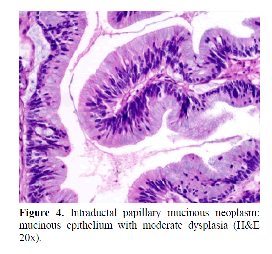 pancreas-papillary-mucinous-neoplasm