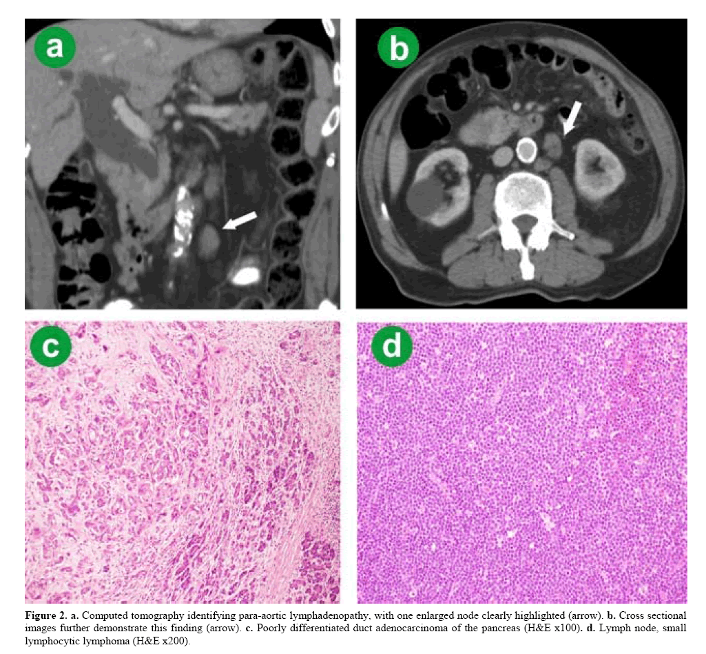 pancreas-para-aortic-lymphadenopathy