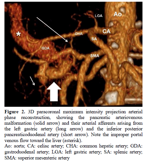 pancreas-paracoronal-arterial-pancreatic