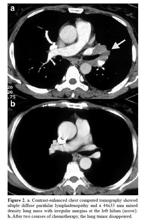 pancreas-parahilar-lymphadenopathy