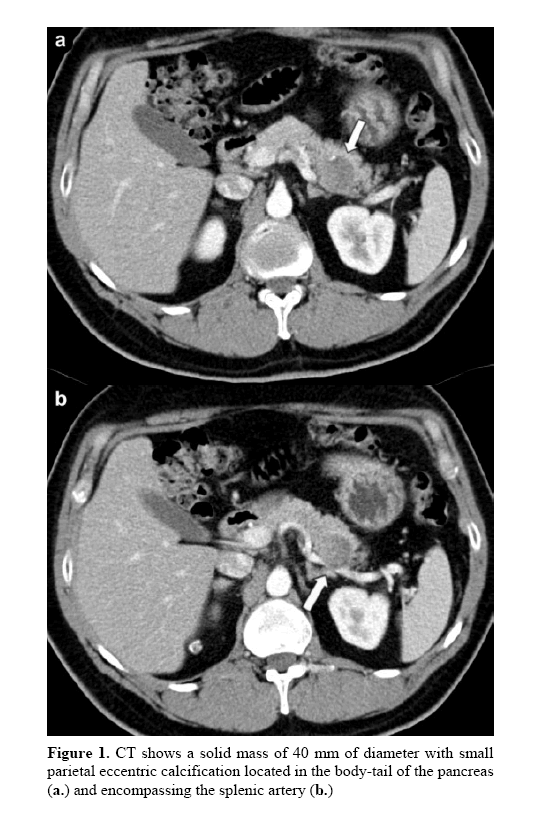 pancreas-parietal-eccentric-calcification