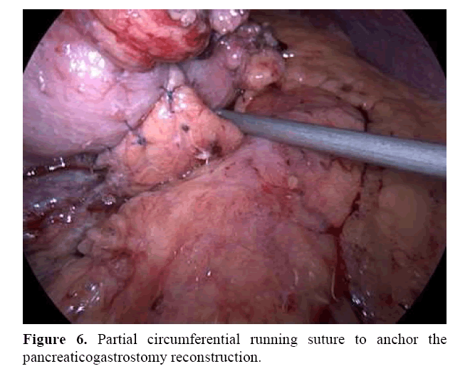 pancreas-partial-circumferential-running