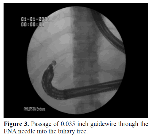 pancreas-passage-guidewire-biliary-tree