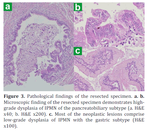 pancreas-pathological-microscopic-pancreatobiliary