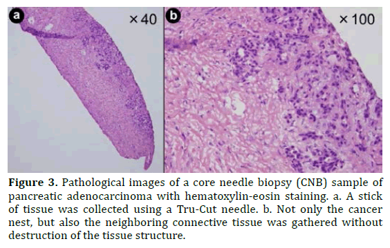 pancreas-pathological-pancreatic-adenocarcinoma