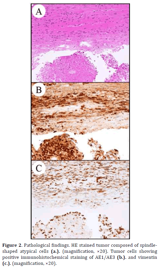 pancreas-pathological-tumor-immunohistochemical