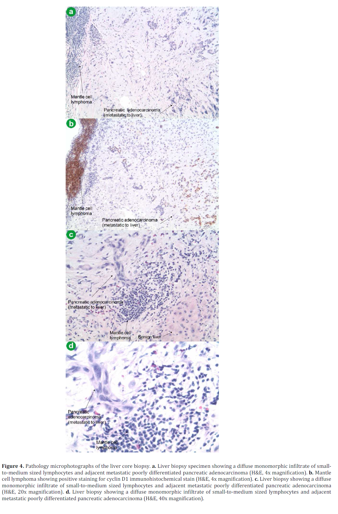 pancreas-pathology-microphotographs-liver